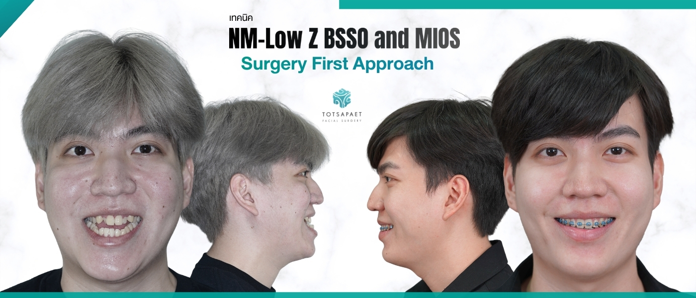 https://dev.totsapaetsurgery.com/wp-content/uploads/2026/03/เวป1400x600-1.jpg
